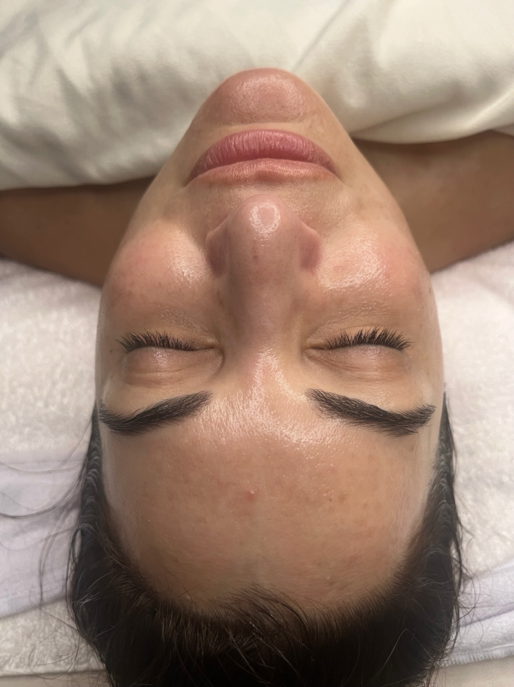 chemical peel