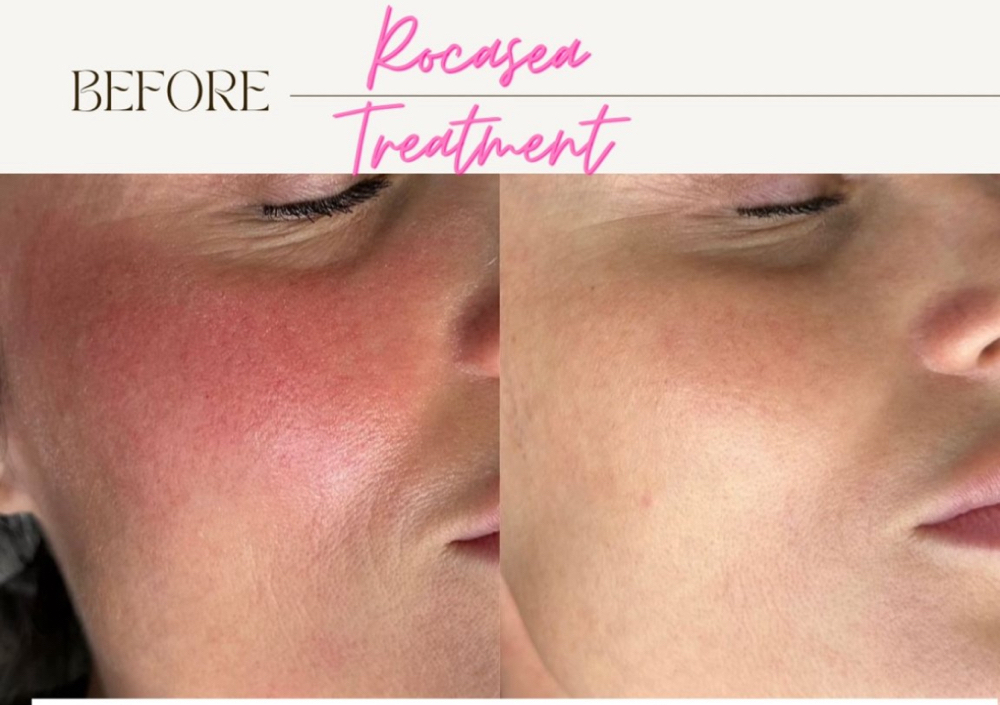 Rosacea/diffuse redness Package 4