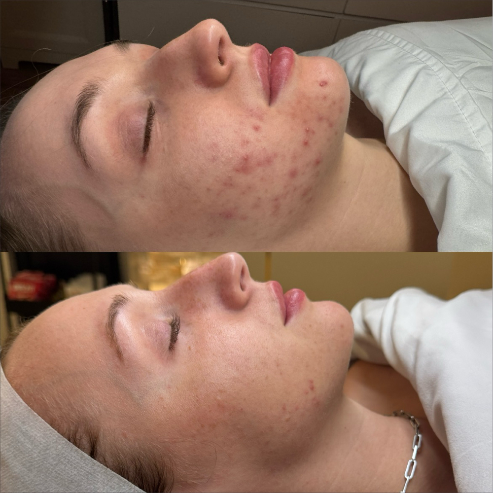 Clear Skin Program Biweekly Facial