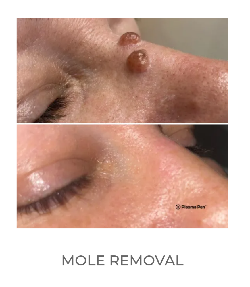 Mole and Skin Tag Removals