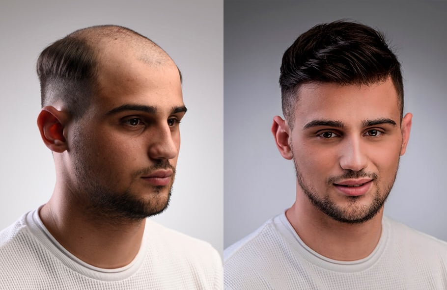 Men Hair System Consultation