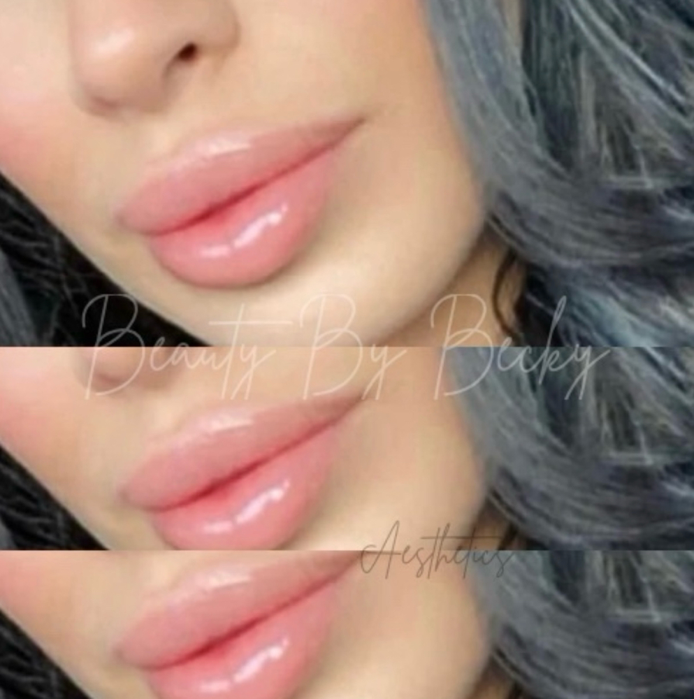 Mini Plump Juverderm