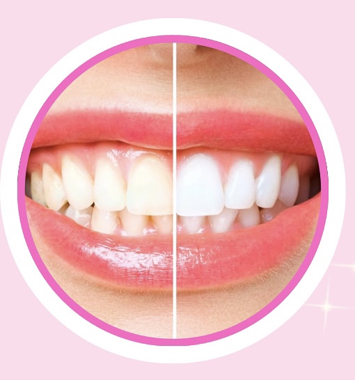 Teeth Whitening at Misty Lashes Luxe in Fresno, CA