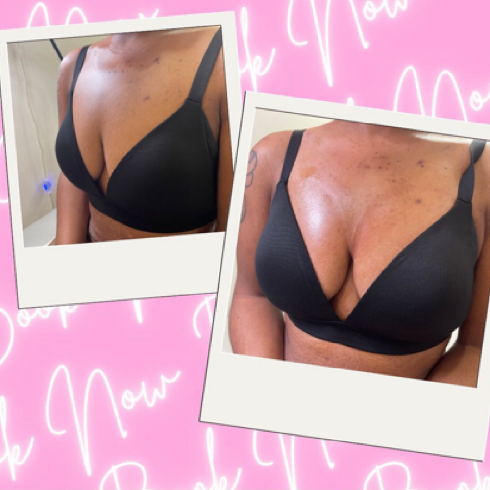 BREAST PLUMPING at Esthiology Skin Lab in Nottingham, MD