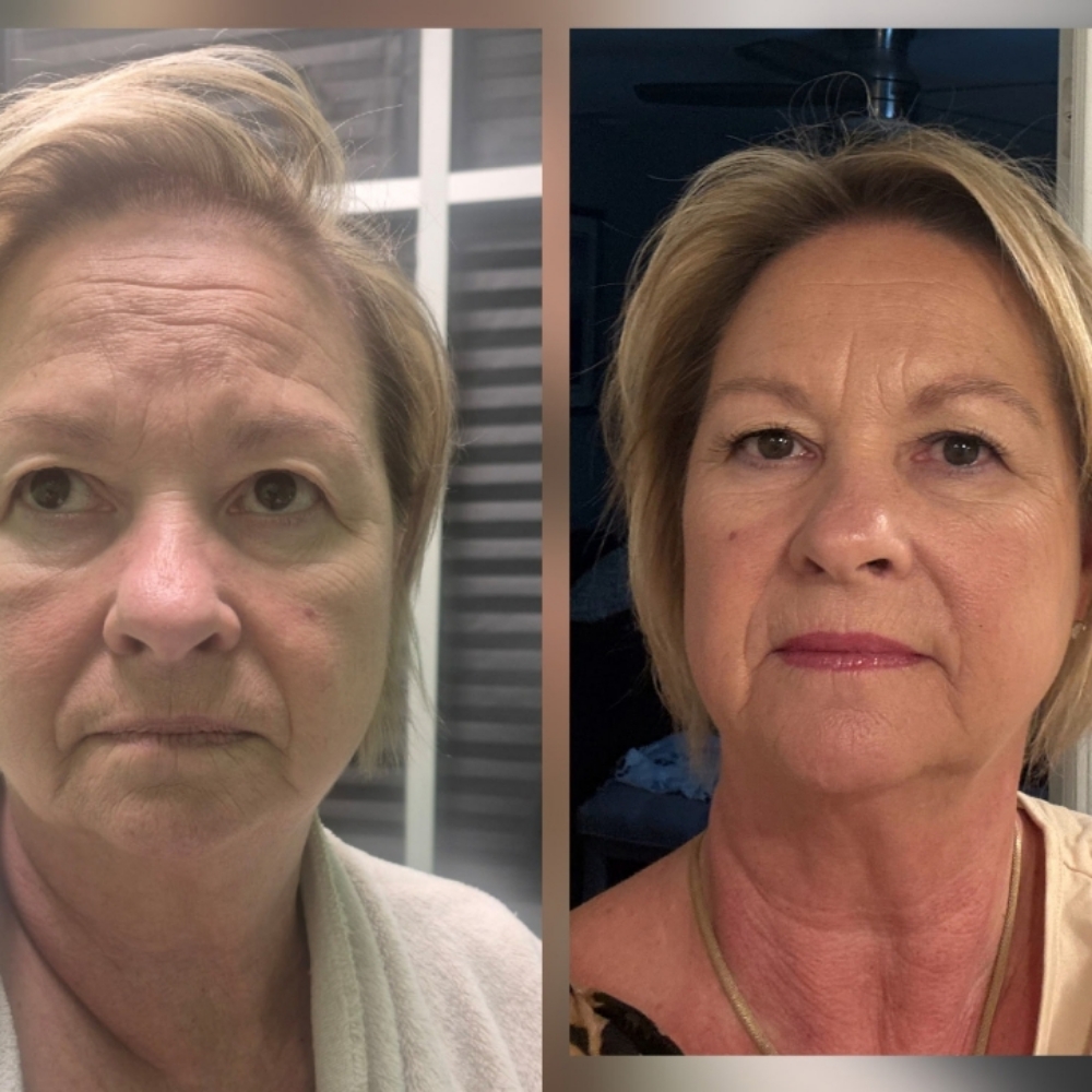First-Time Client Special: $125 at JUST BEAUTIFUL SKIN in Goose Creek, SC