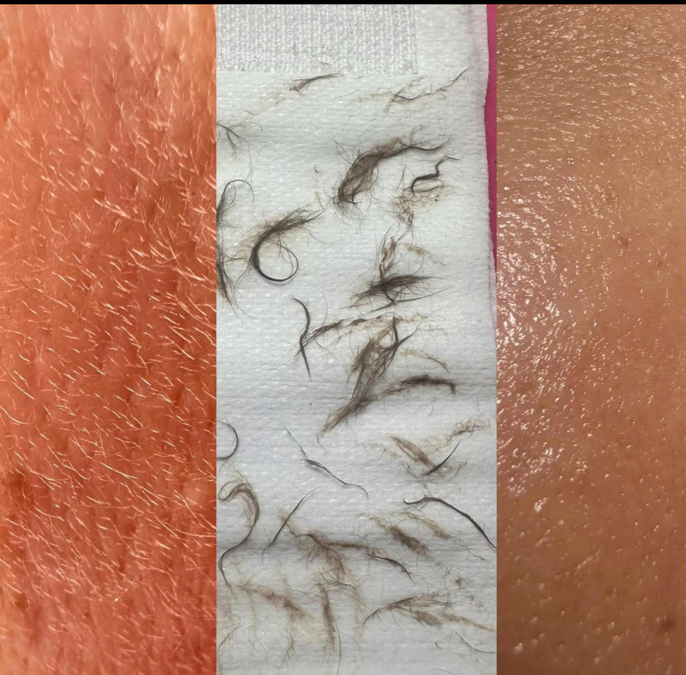 Dermaplaning