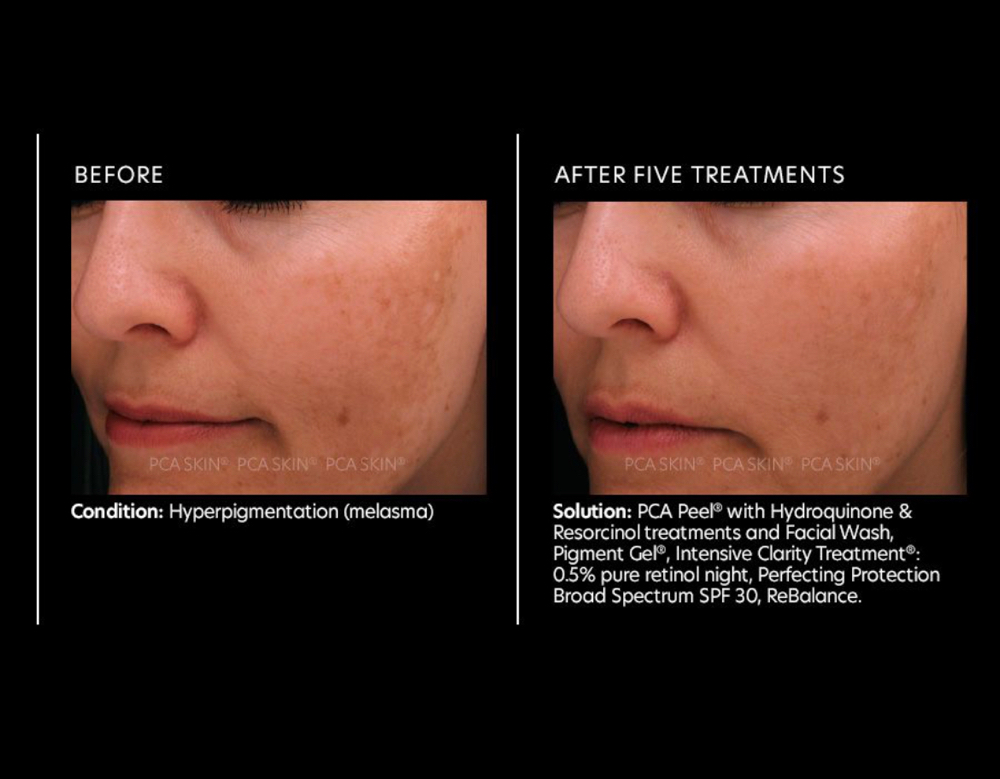 Chemical Peel Treatment