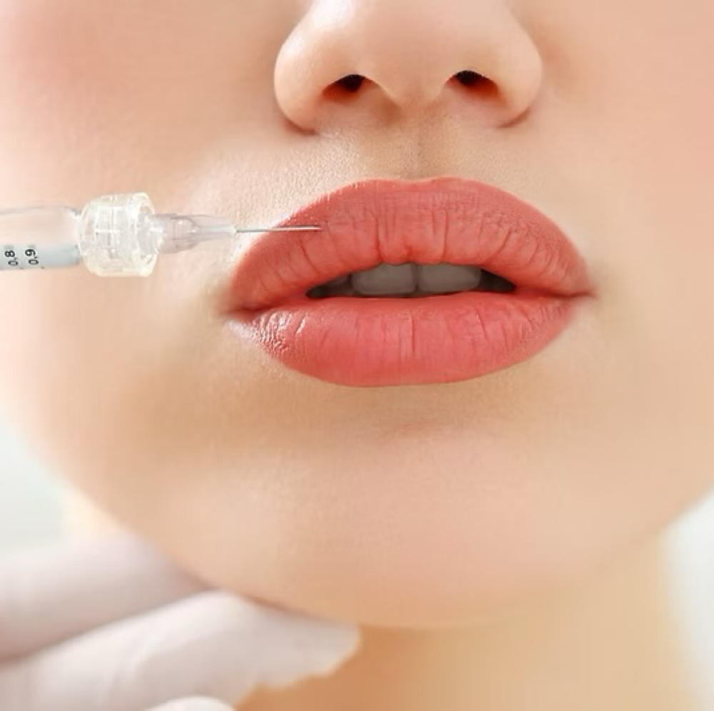 PRP Lip Filler (3 Sessions) at Chatuge Med Spa & Fitness in Hiawassee, GA