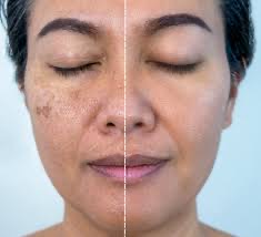 Melasma treatment