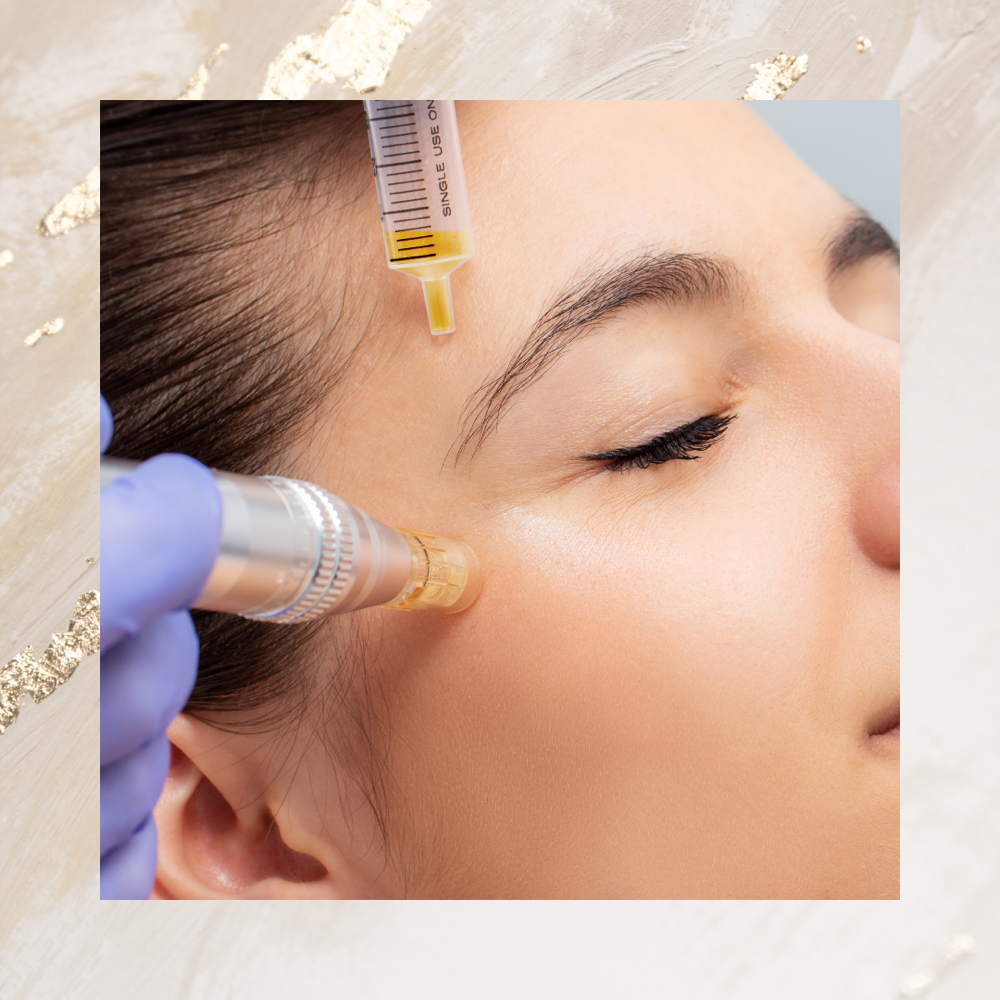 Microneedling