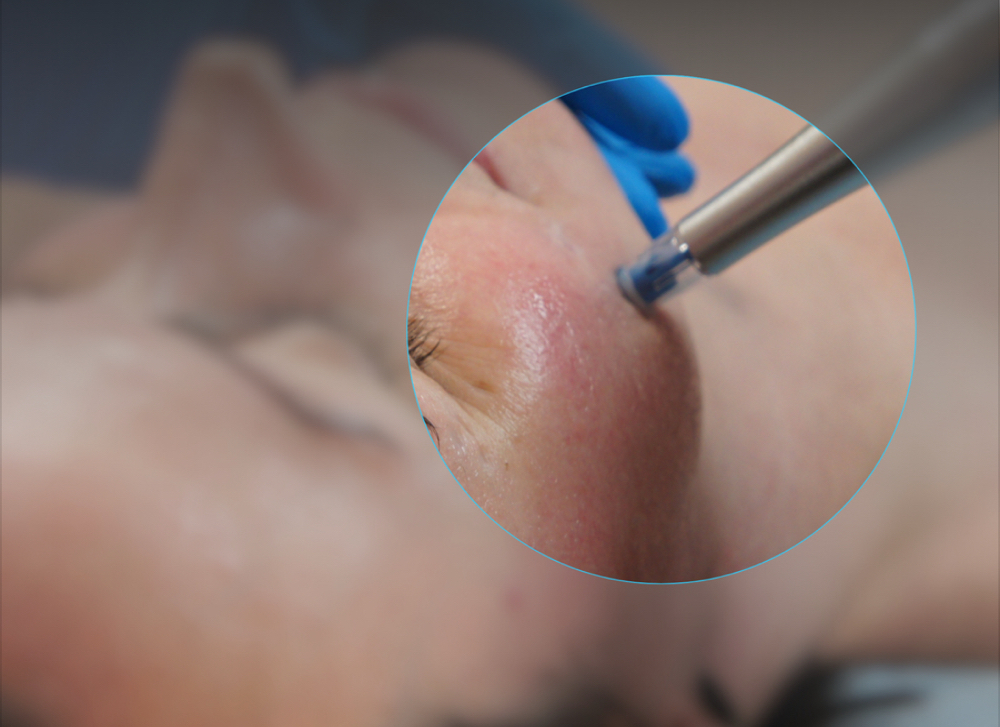 Rezenerate Facial with Microdermabr