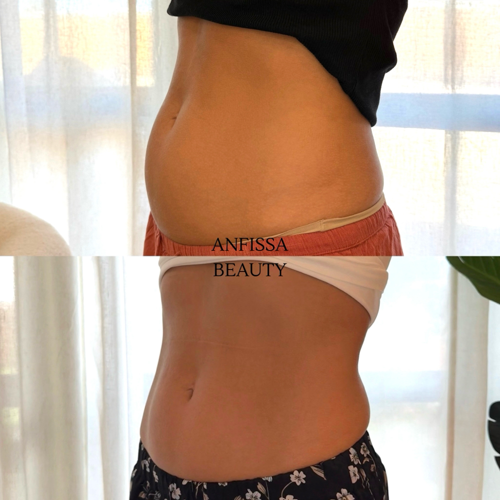 First time Cryoskin