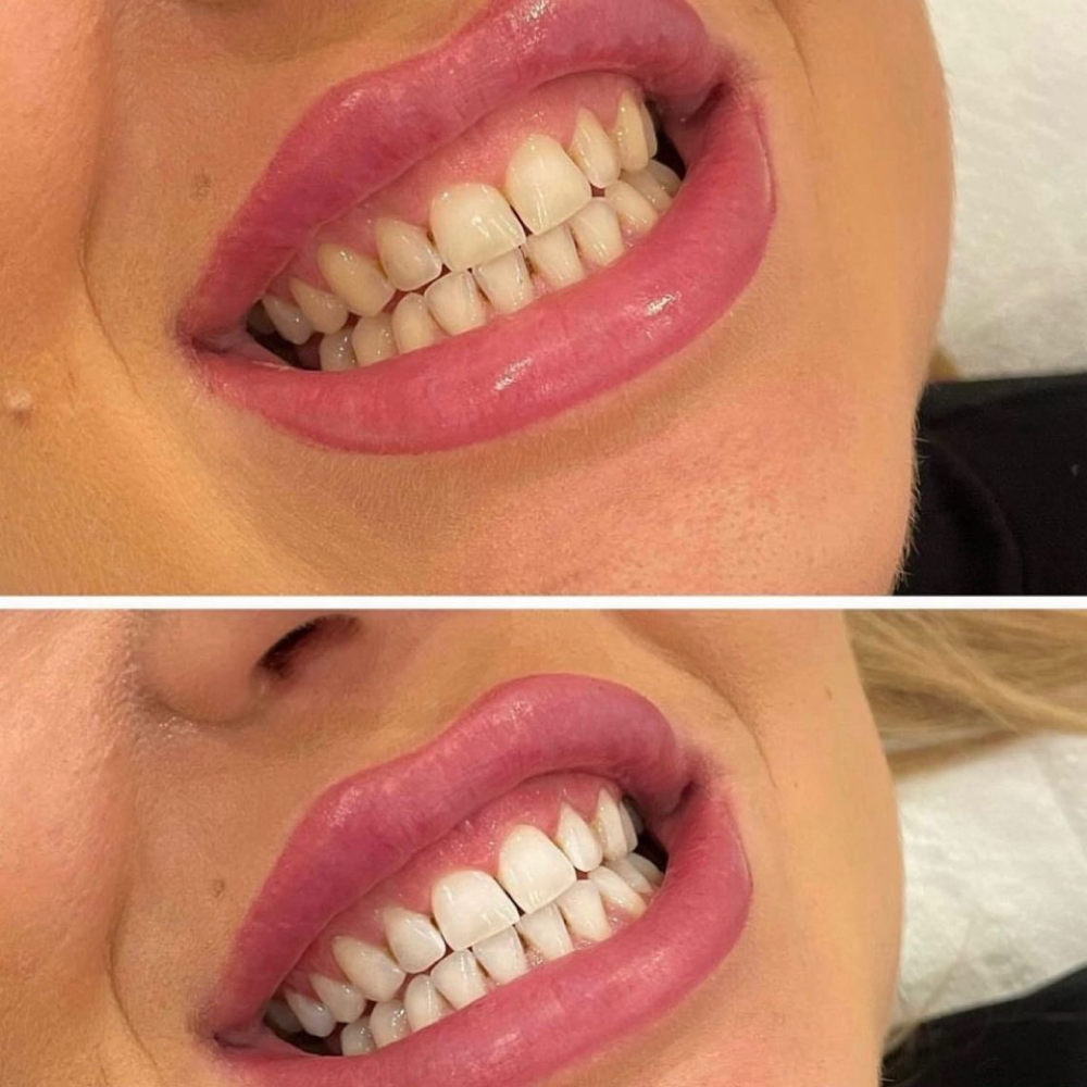 Teeth Whitening at Daisy’s Beauty Bar in Scottsdale, AZ