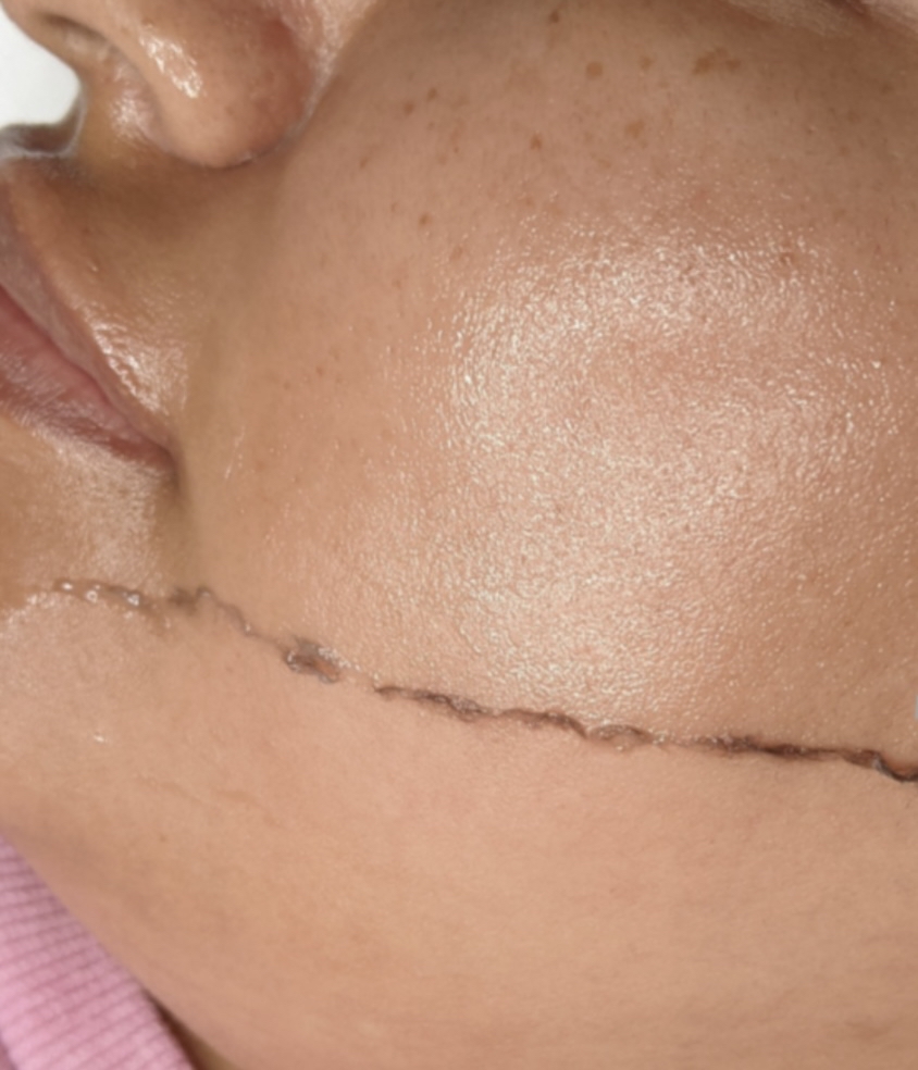 Dermaplaning Only