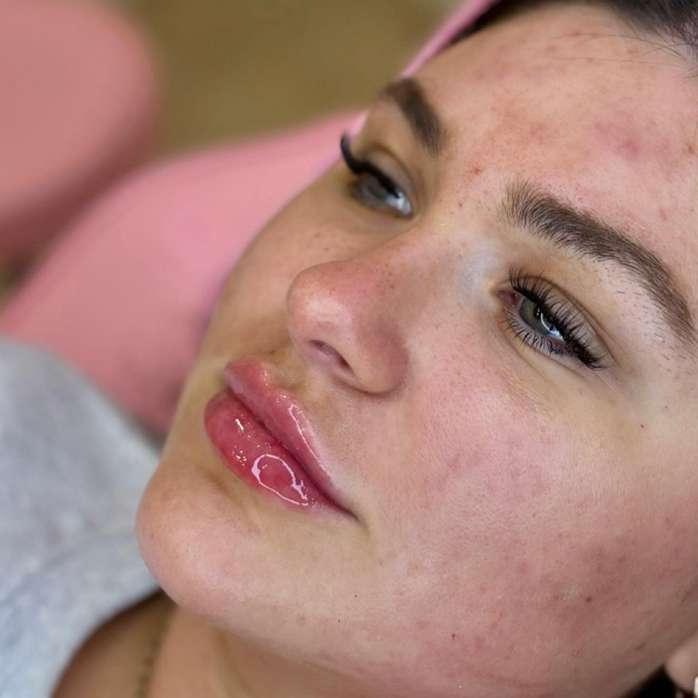 Juvéderm Volbella® XC Lip Filler✨ at The Skin Room Med Spa in Marshall, TX