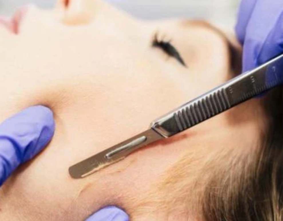 Dermaplane at V Esthetics in Lynn, MA