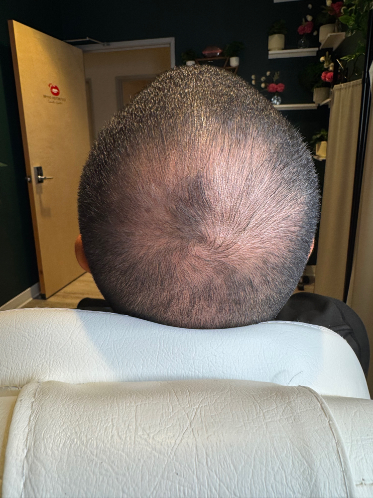 Hair Exosome Treatment