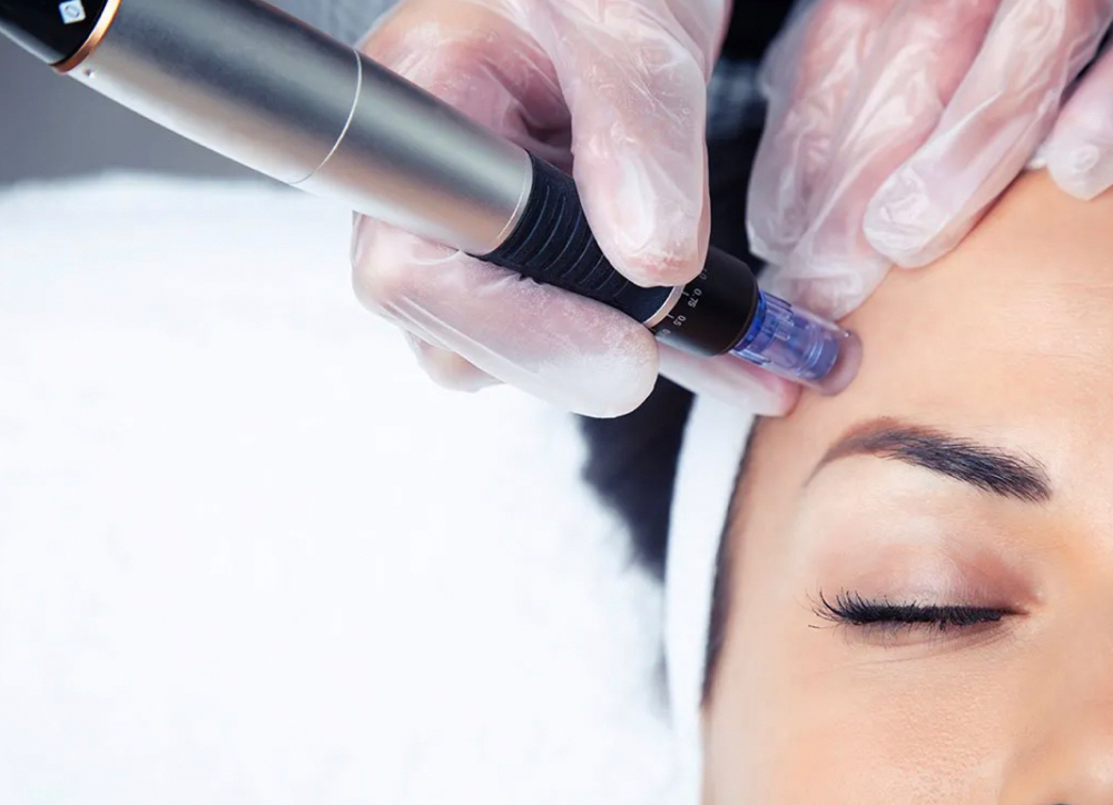 Microneedling