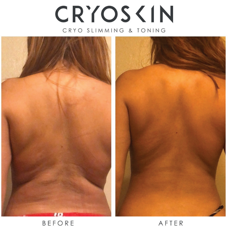 Cryoskin: Toning