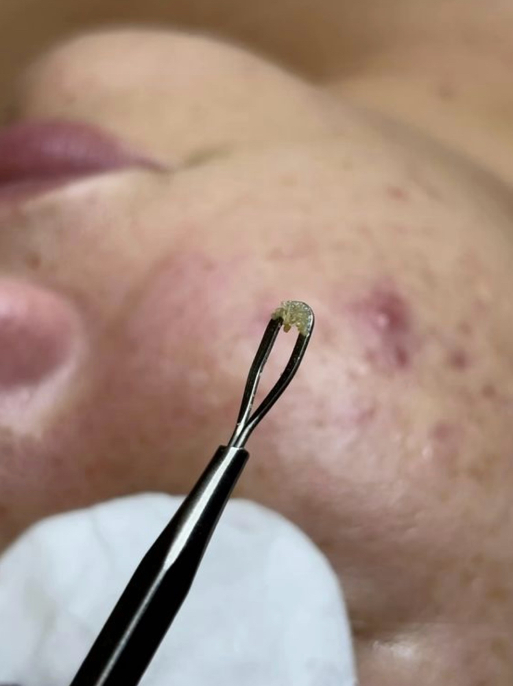 🧼Clear Glow Detox Facial🧼