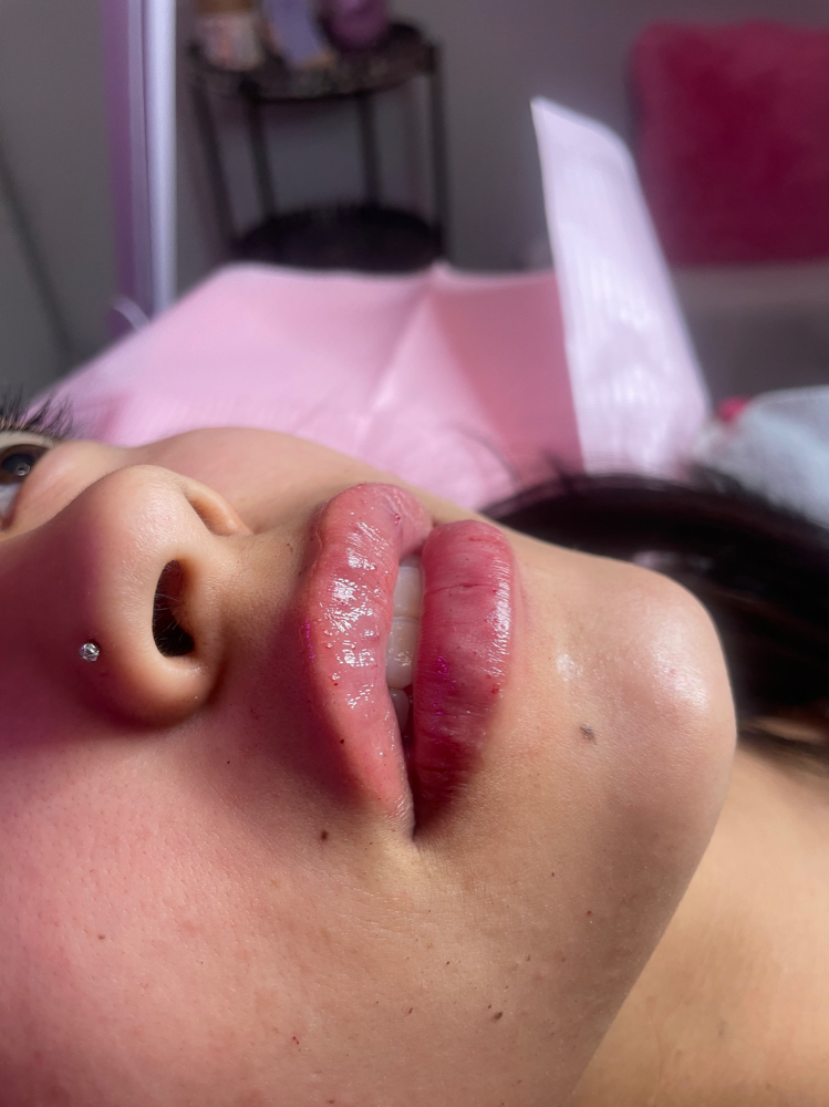1.5ml Of Lip Filler