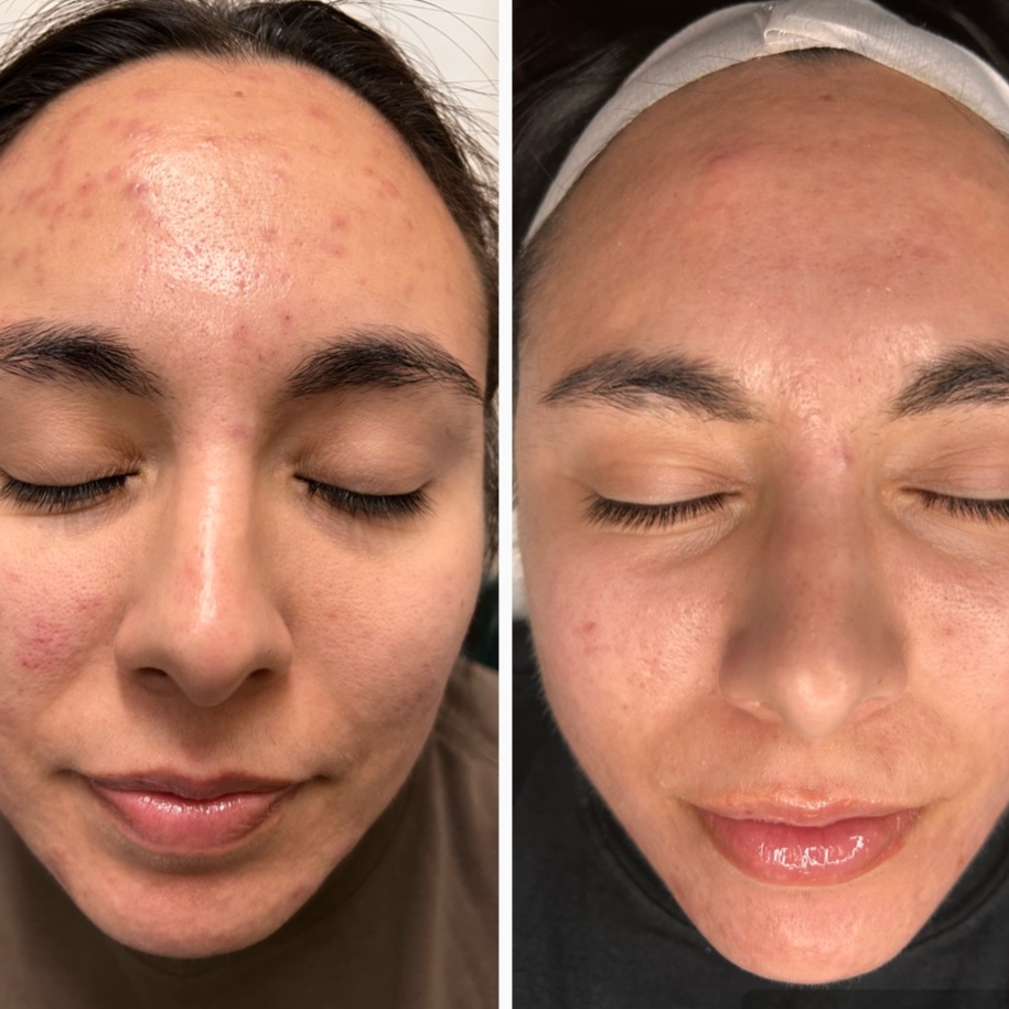 AC DUAL Acne Treatment at Skin Corrective Aesthetics in Dallas, TX