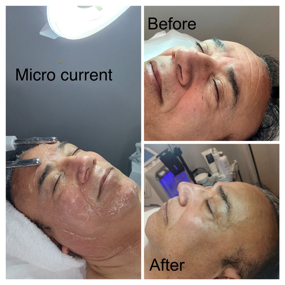Microdermabrasion(full Service)