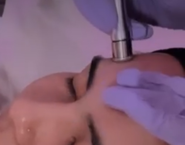 Microdermabrasion ADD ON