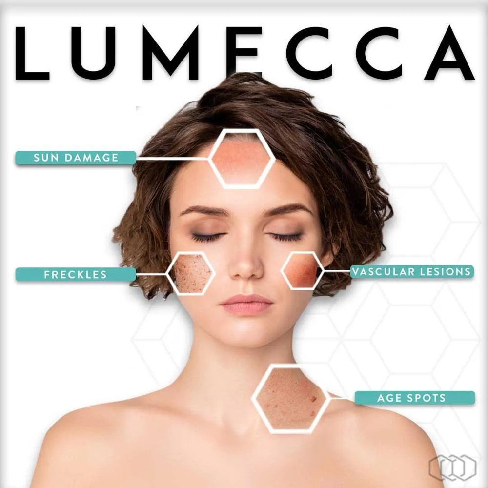 IPL Photofacial