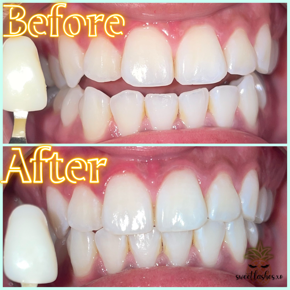 Teeth Whitening