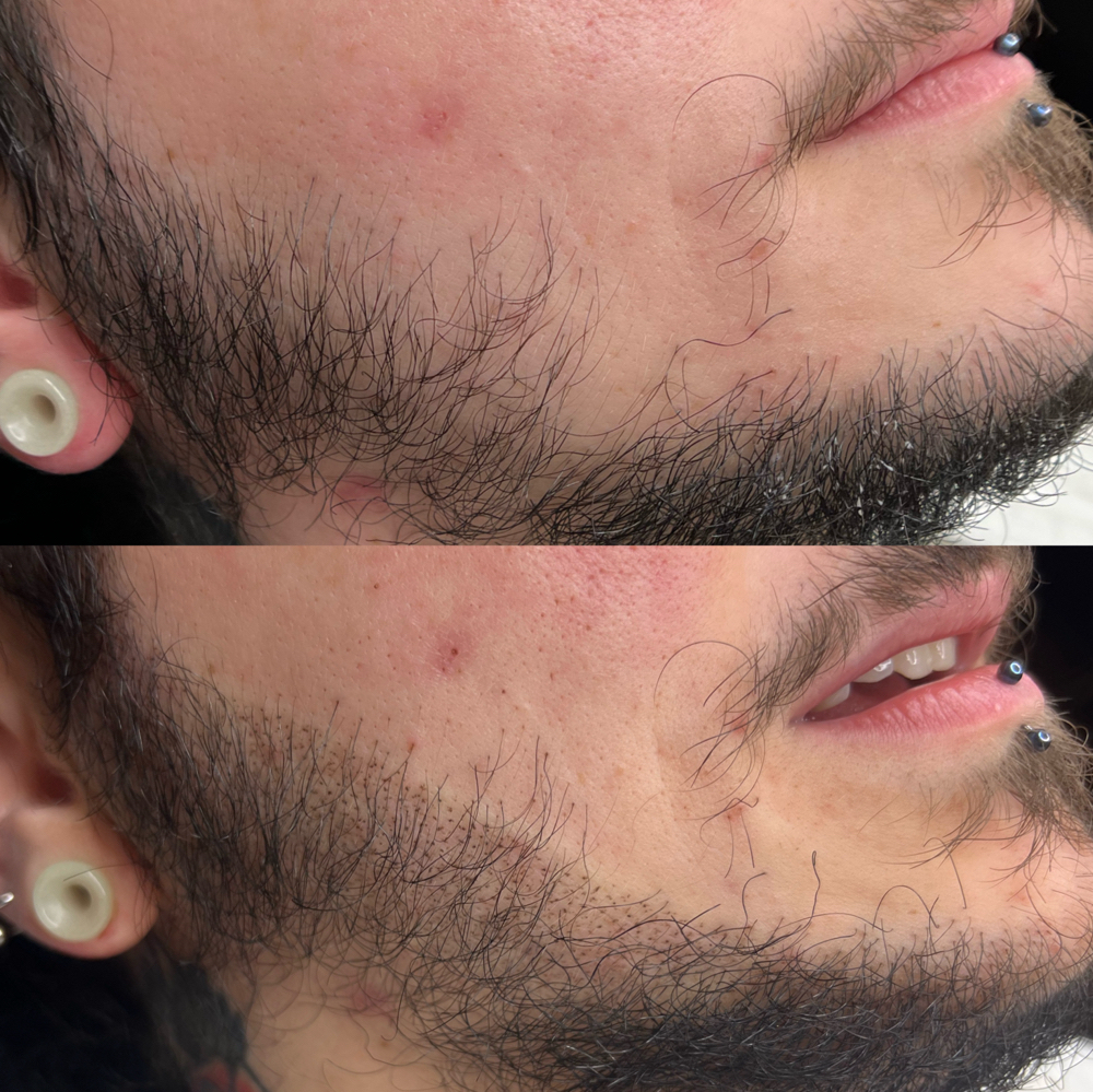 Facial Hair Restoration Tattoo