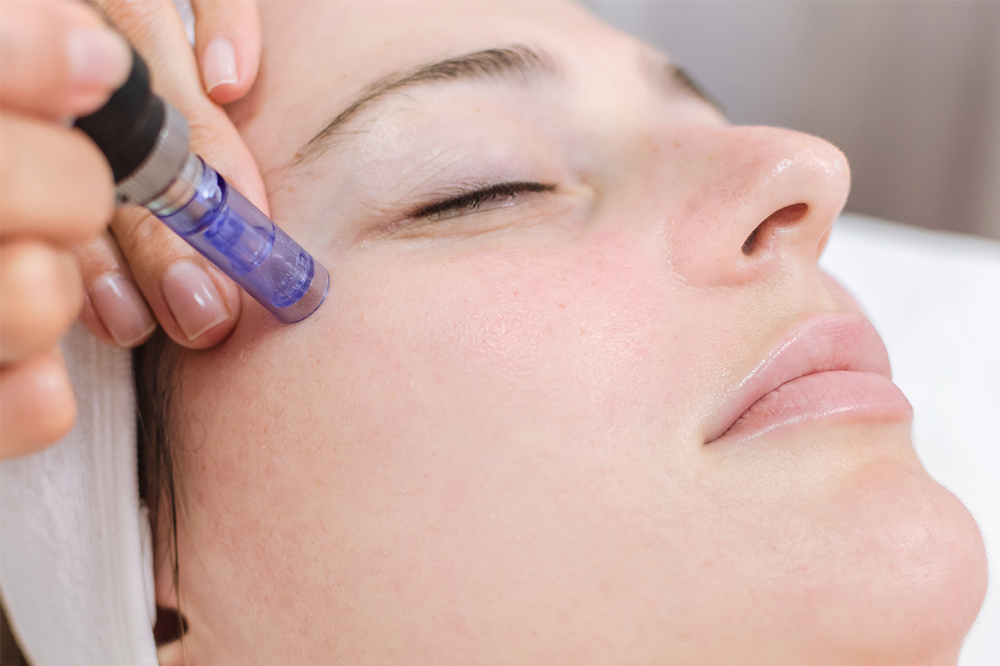 MICRONEEDLING PACKAGE OF 5