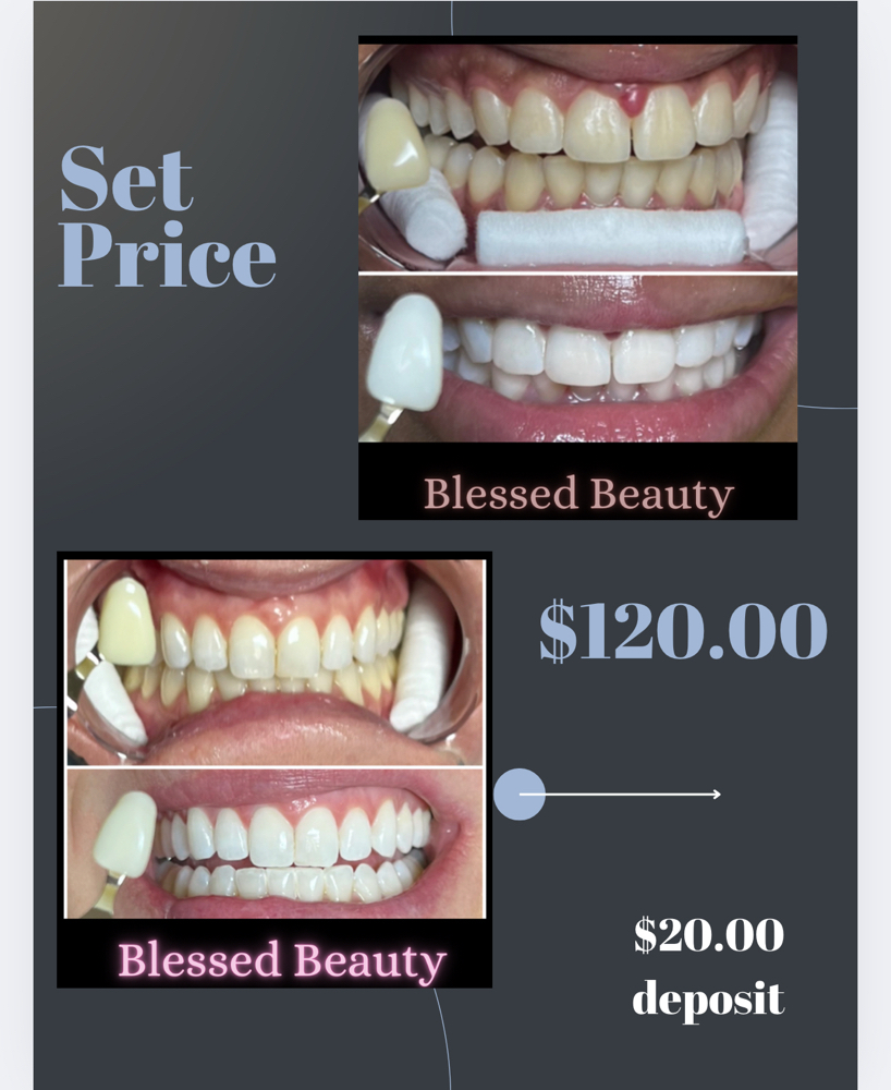 Teeth Whitening Set Price! at Blessed Beauty in El Paso, TX