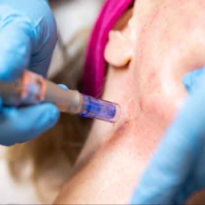 MicroNeedling Neck Add On at Skin Boutique North Carolina in Mooresville, NC
