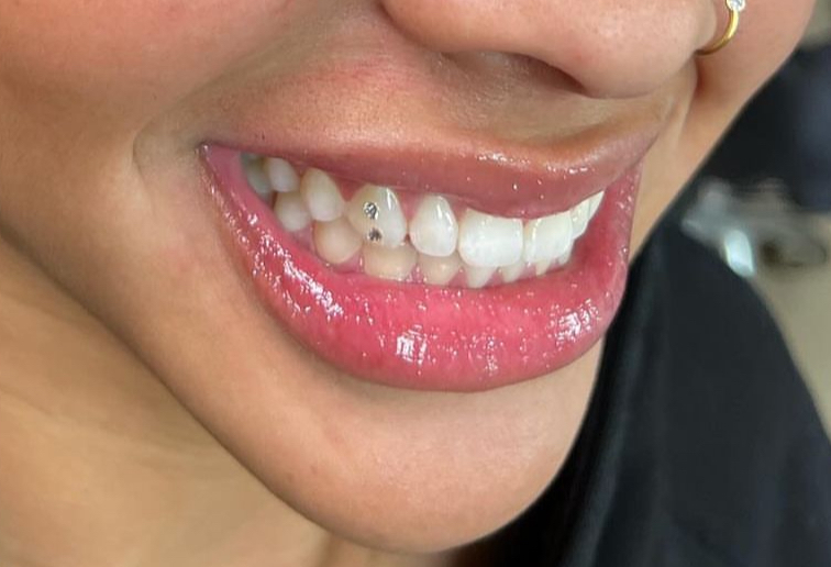 Two Tooth Gems