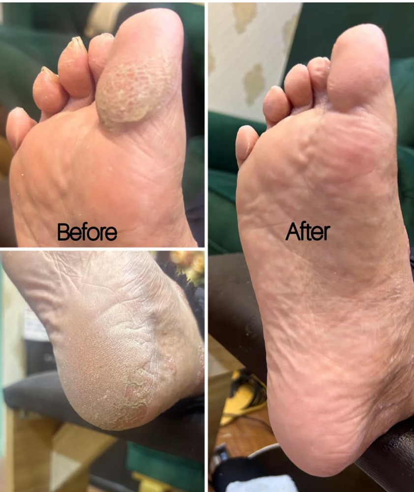 Dry Pedicure