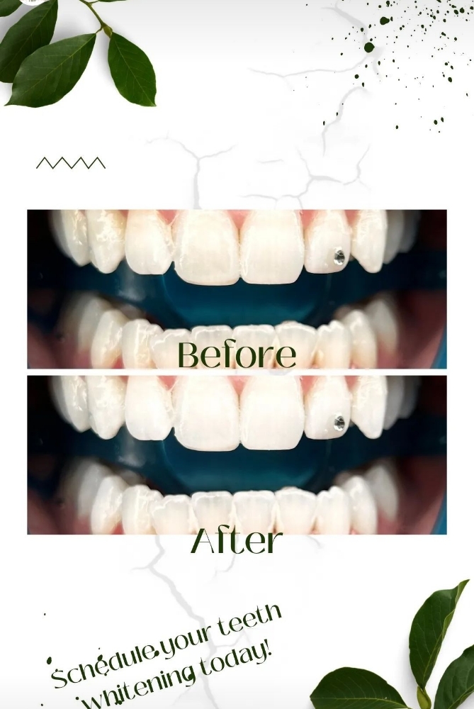 Teeth Whitening