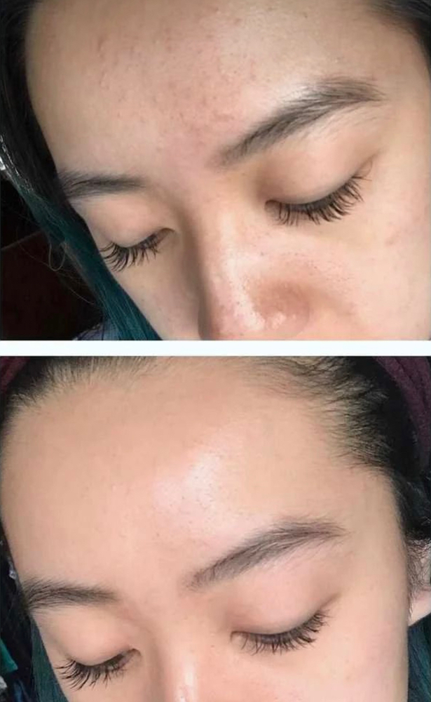 Acne Treatment Facial at MP Aesthetics & Beauty LLC in Foley, AL