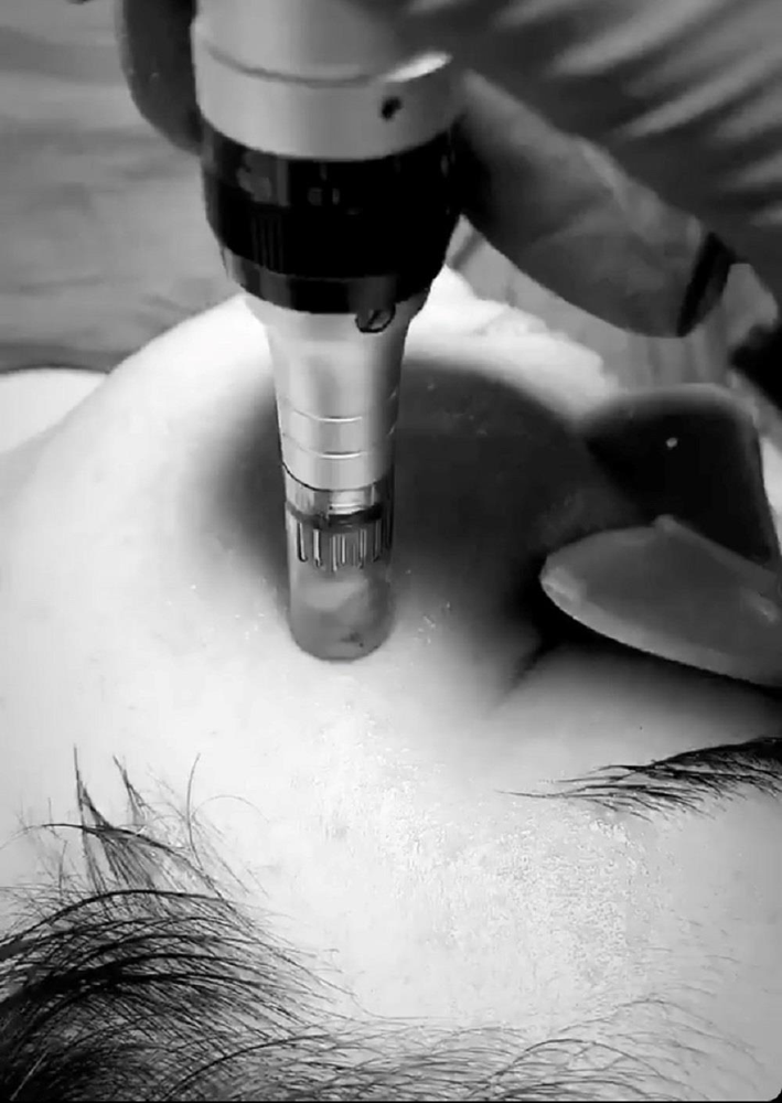 Microneedling + Chemical peel Combo