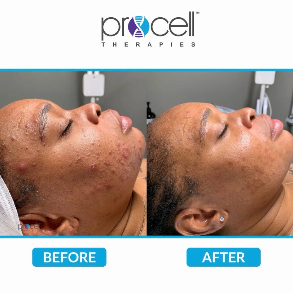 Peel + Collagen Recode Combo at TouchedByTyHairCo in San Antonio, TX