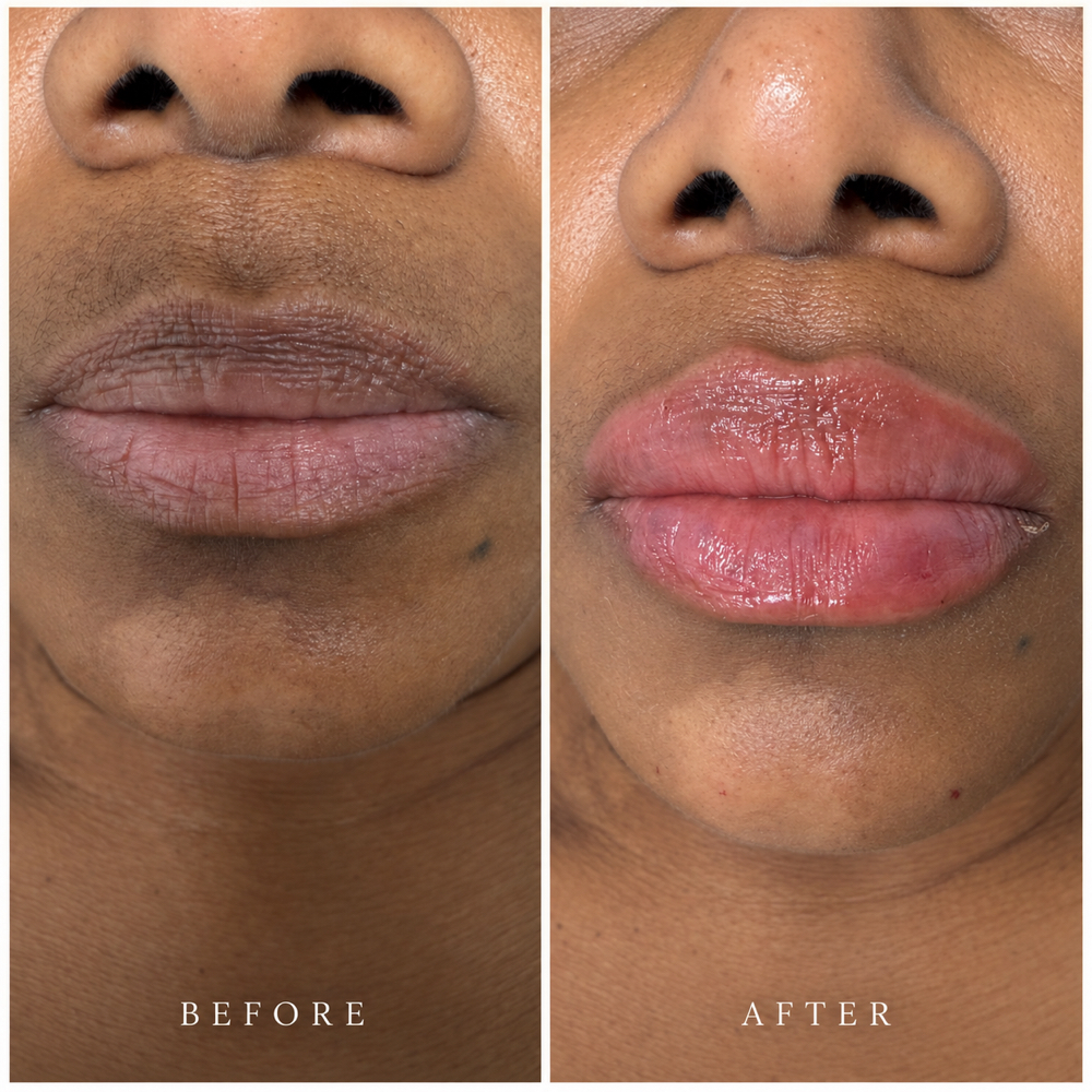 The Mily lip Sculpt at Mily Aesthetics in Newark, NJ