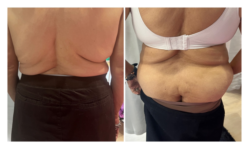 Skin Tightening Treatment