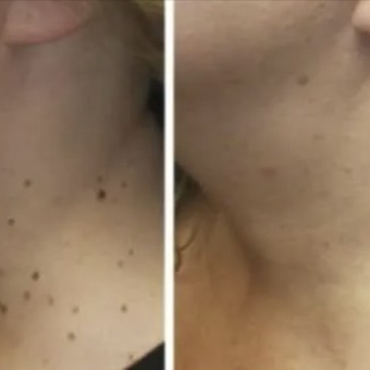 Skin Tag Removal at Bliss Beauty Bar in Houston, TX