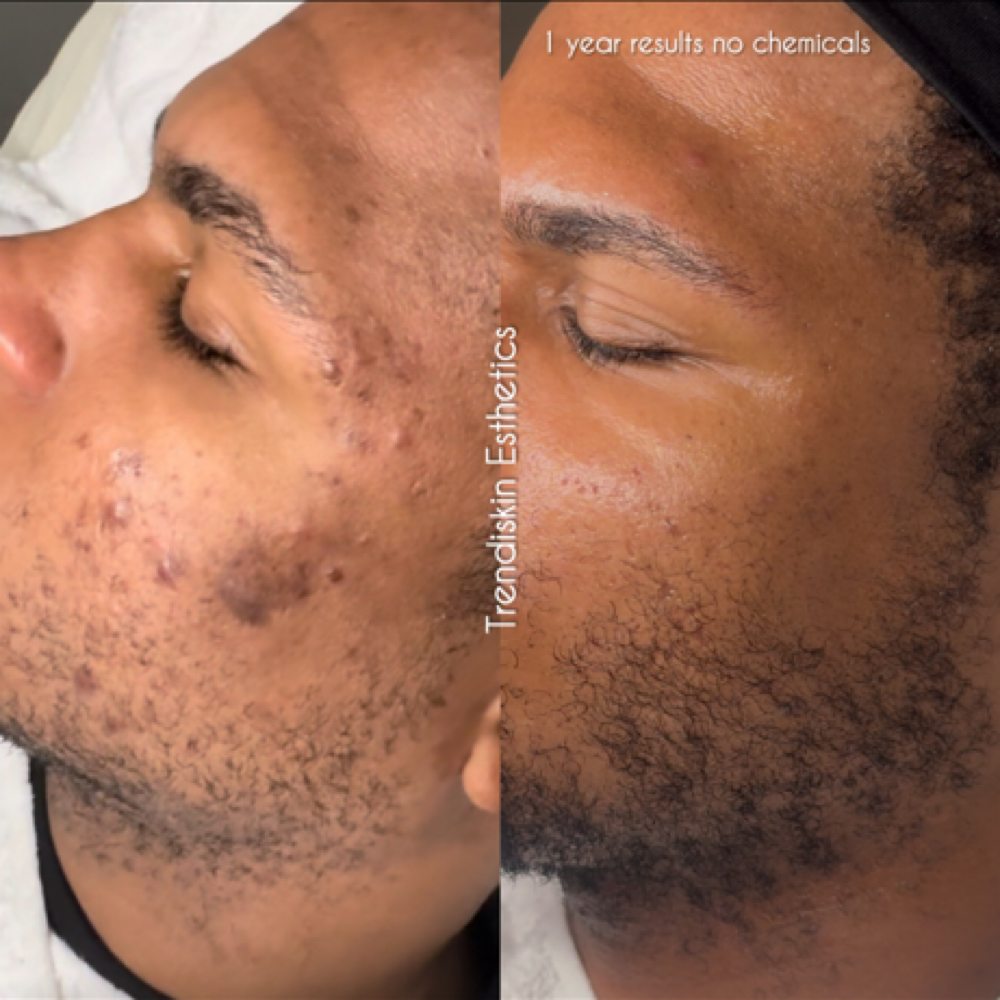 Acne Buster at Trendiskin Esthetics in Baton Rouge, LA