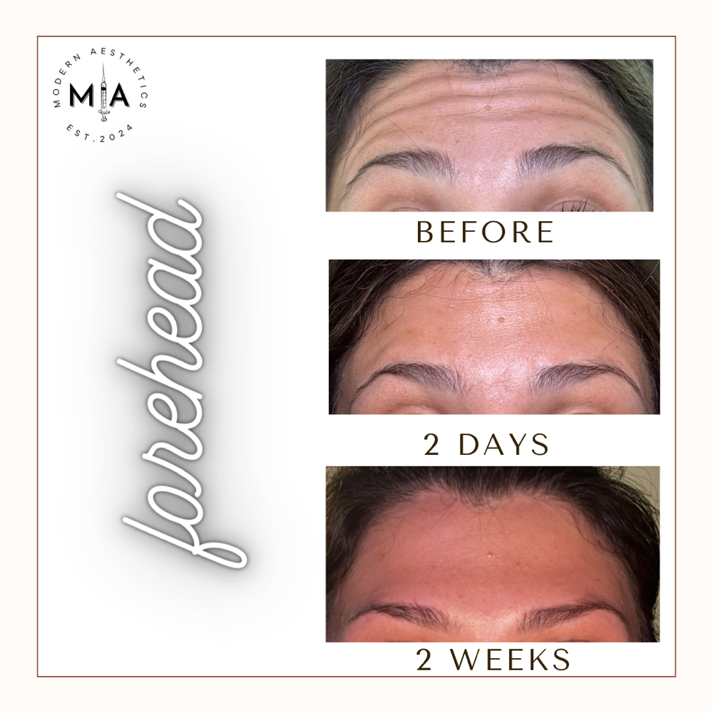 Forehead Lines