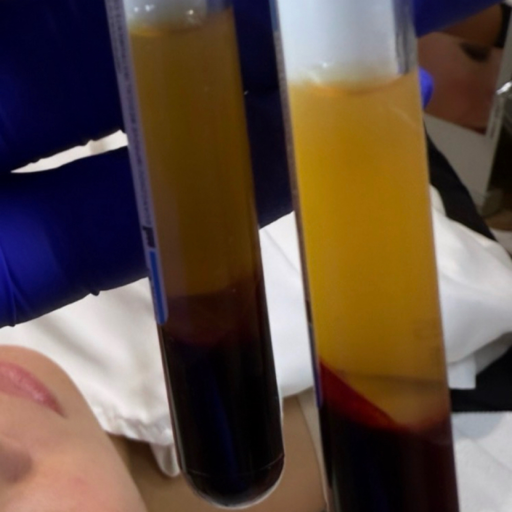 Signature Exosome PRP Therapy 3tre at It’s Your Beauty Time in Downey, CA