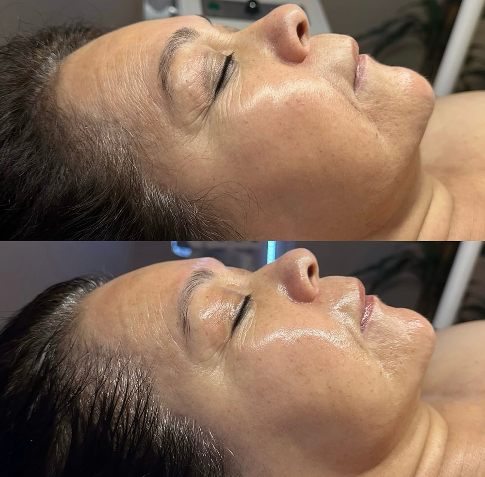 ANTI-AGING FACIAL