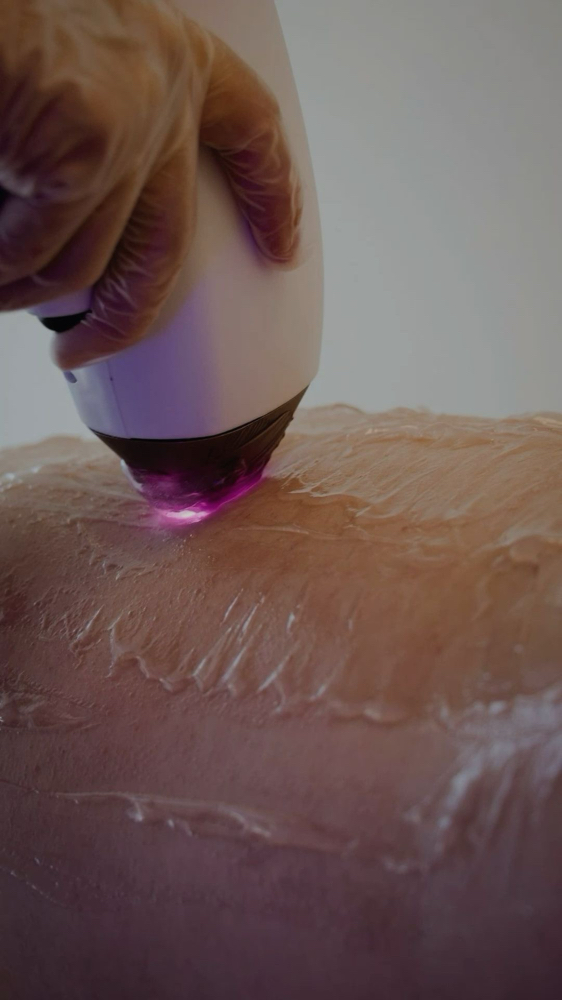 Laser Hair Removal Bundle