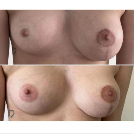 Areola Restoration at Beyond The Scar in Leander, TX