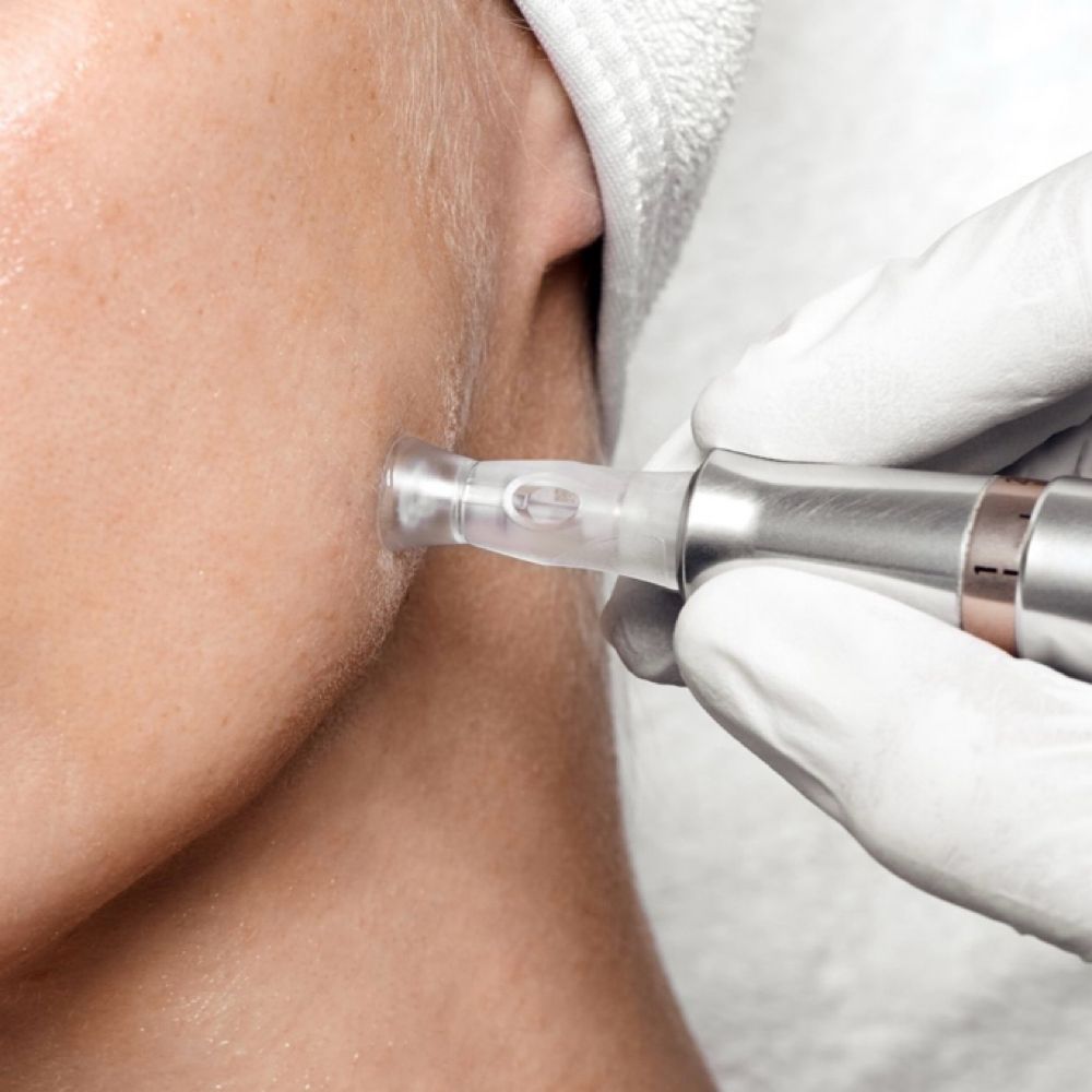 Microneedling With Salmon DNA at The Glow Studio in Wappingers, NY